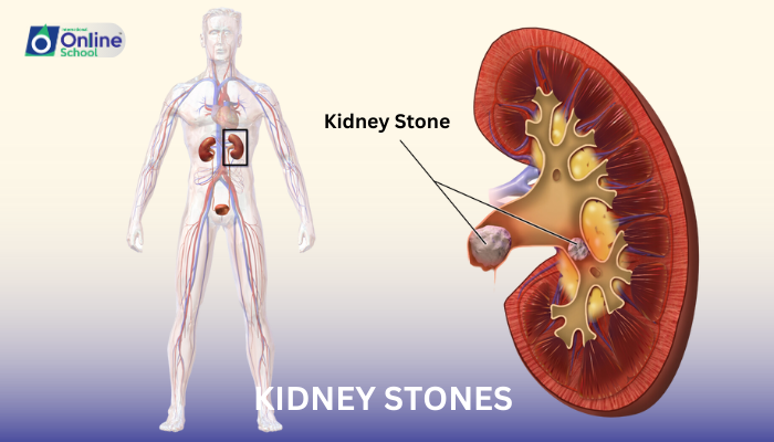 Lesson 13: Kidney Stones and Their Management